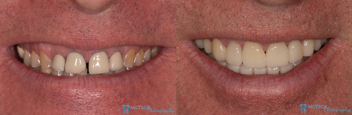 Permanent Smile Results
